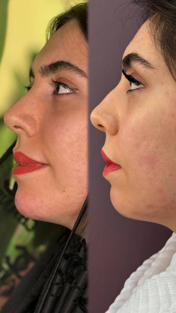 فیلر چانه