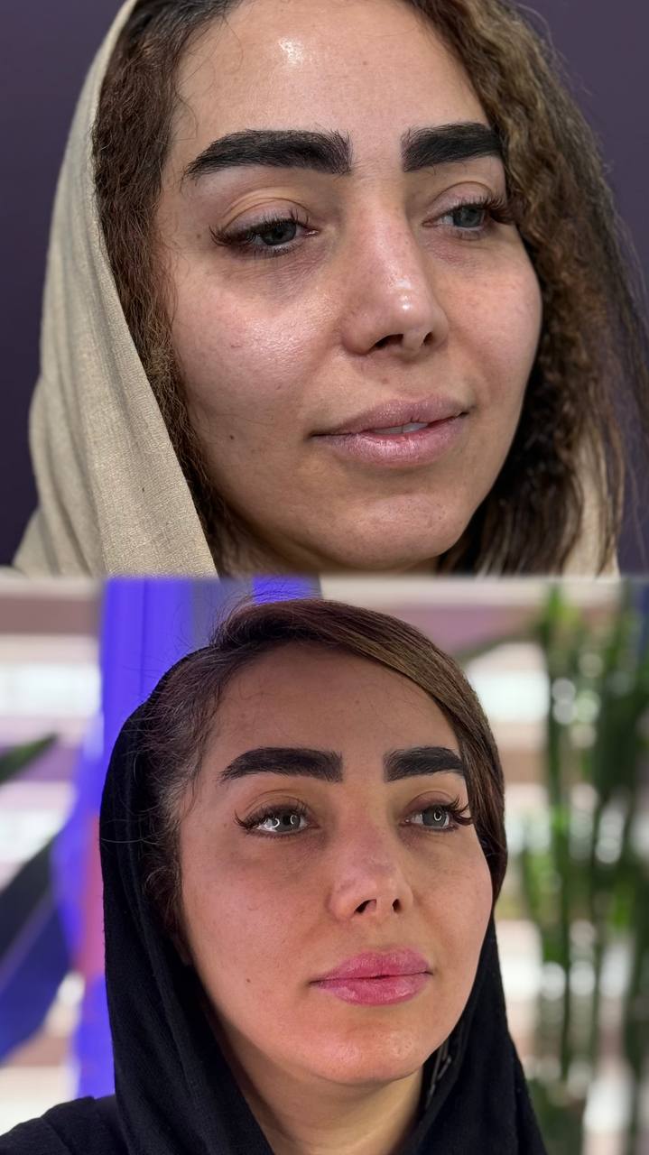 جوانسازی و مادلنیگ