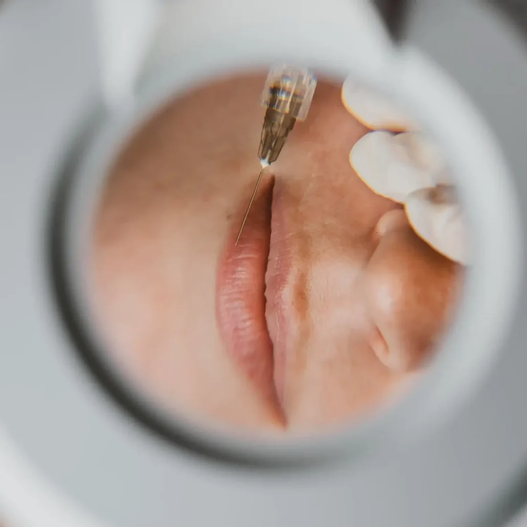 تزریق ژل لب در قزوین