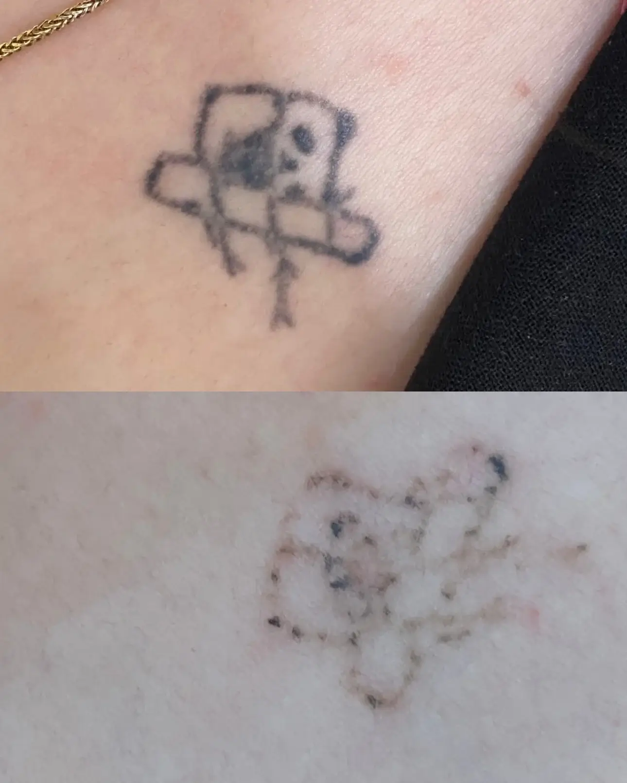 نمونه کار ریمو تتو با لیزر