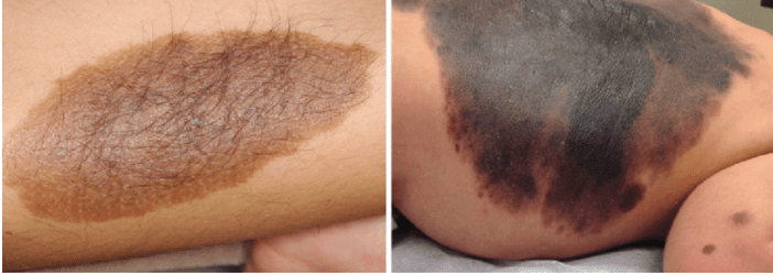 خال های مادرزادی بزرگ 