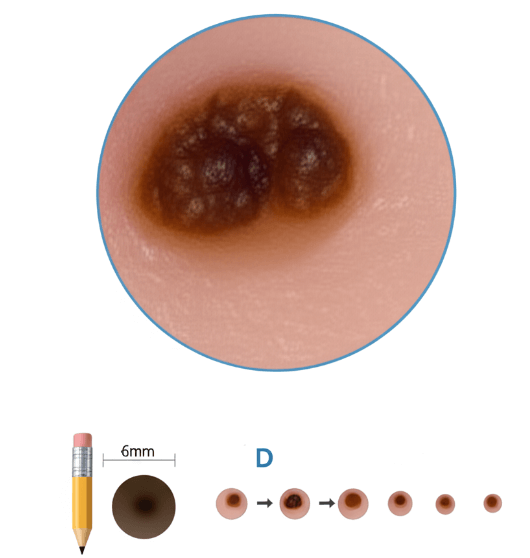 عکس از قطر طبیعی خال